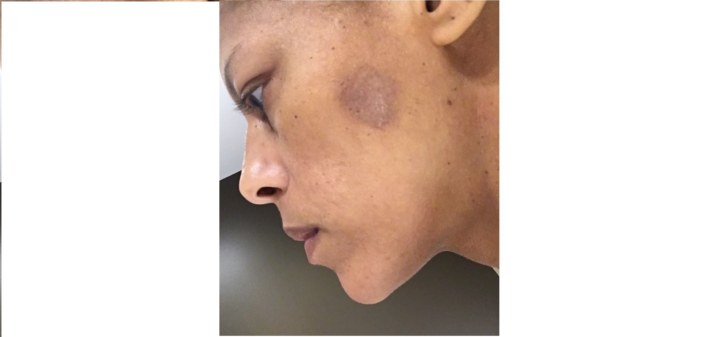 Brûlée au visage lors d’un massage