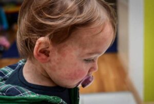 Rougeole: Ski Saint-Bruno et les Promenades seraient deux lieux d&rsquo;exposition ciblés